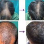 Hair Fall and Regrowth With Hijama Therapy