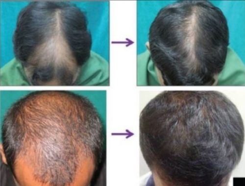 Hair Transplant with Hijama therapy Archives - Model Paper