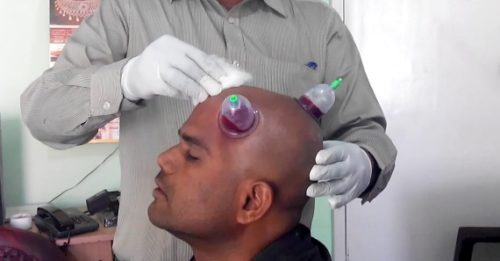 Hair Fall and Regrowth With Hijama Therapy 